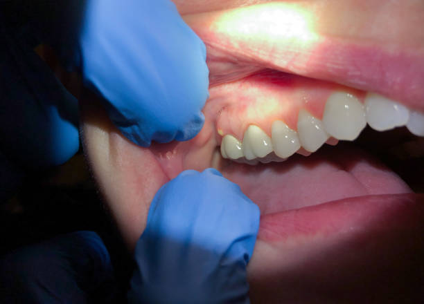 Best Emergency Tooth Extraction in Laurel Hill, VA