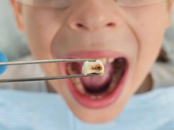 Best Emergency Wisdom Teeth Removal in Laurel Hill, VA